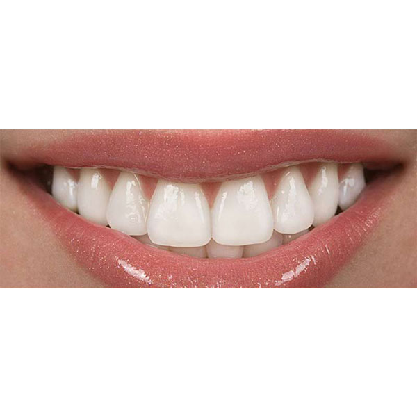 چطور دندان های سفید داشته باشیم